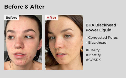 COSRX - BHA Blackhead Power Liquid - 100 ml - Mhalaty